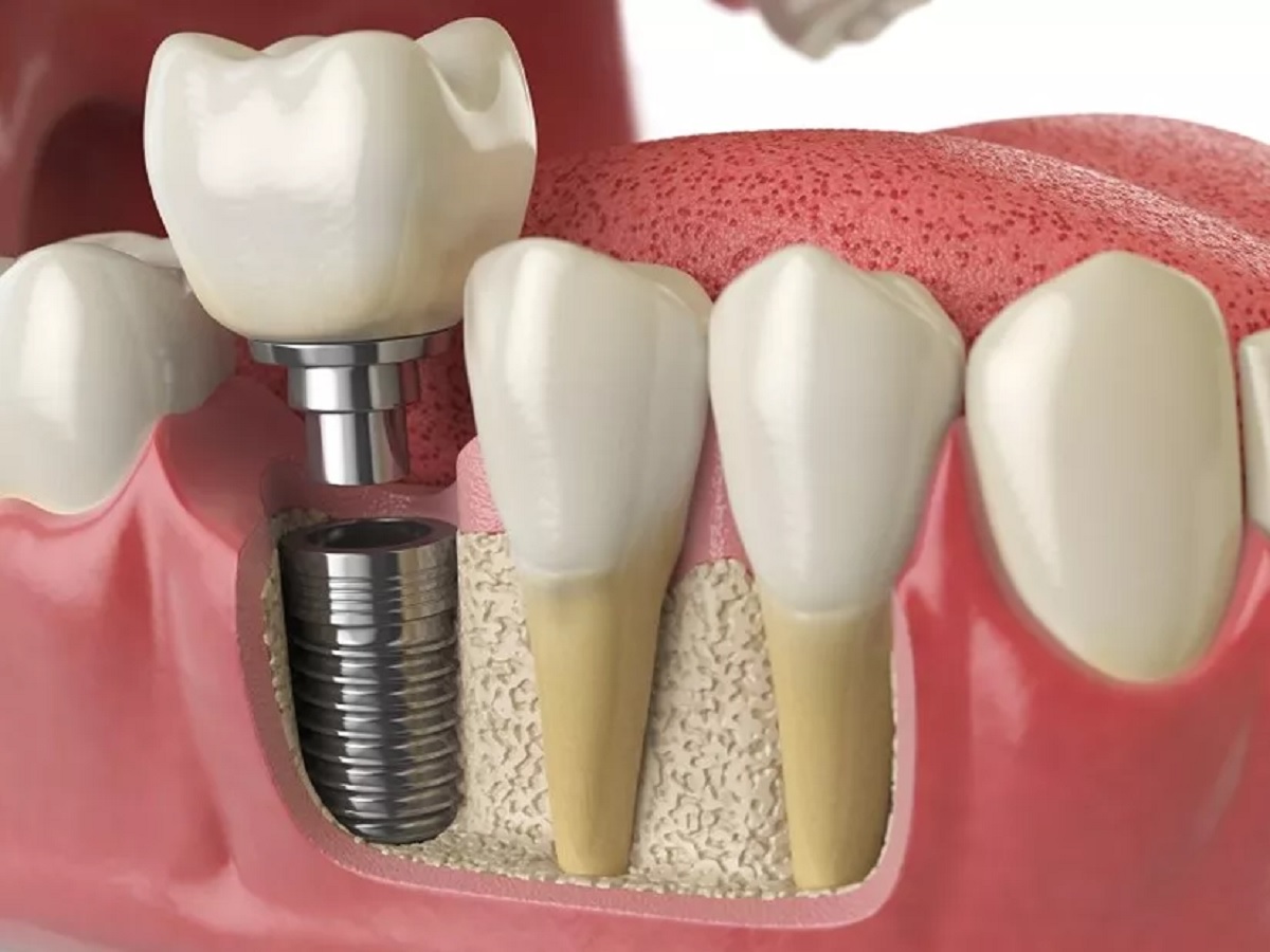 implantes dentales a coruña